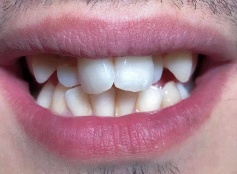 Aligners before treatment